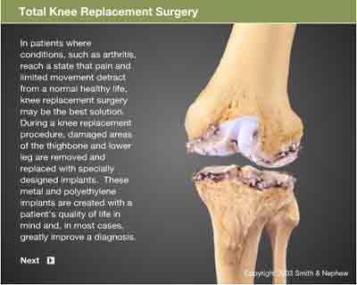 knee replacement screenshot