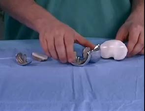 knee implants screenshot